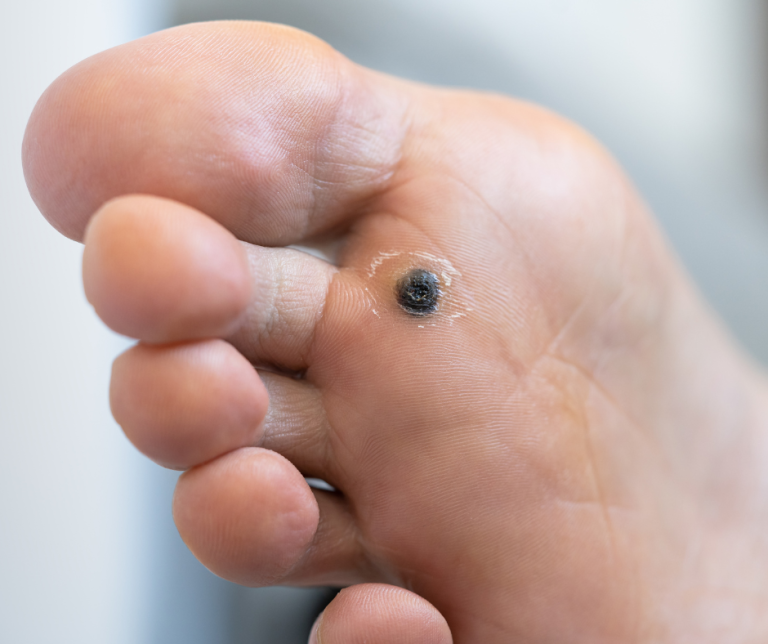 Getting Rid of Plantar Warts (For Good!)
