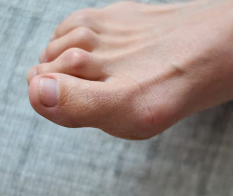 foot with hammertoe